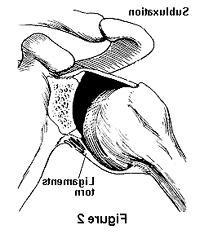 图示肩部韧带撕裂